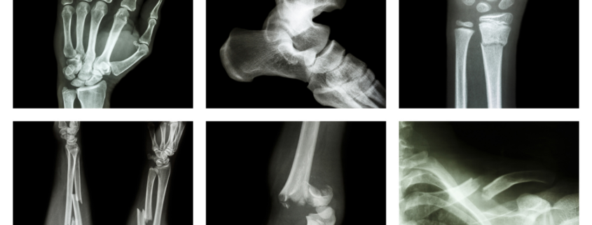 ssd for bone fractures